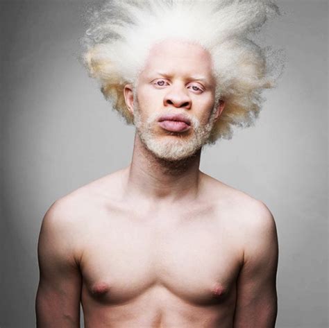 Афроамериканец альбинос