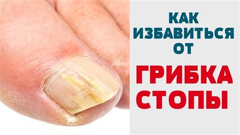 Как лечить грибок ногтей народными средствами быстро быстро видео
