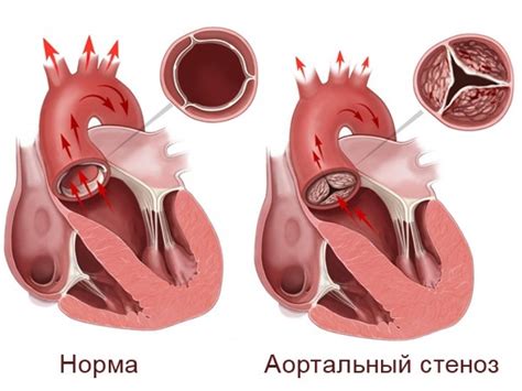 Кальциноз аортального клапана