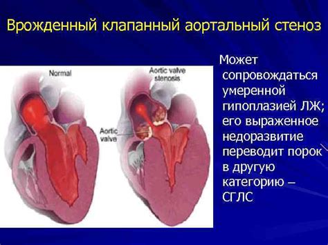 Кальциноз аортального клапана