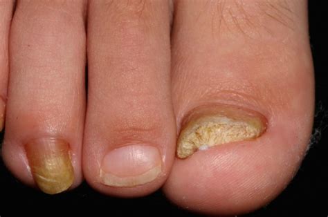 Лечение грибка на ногтях