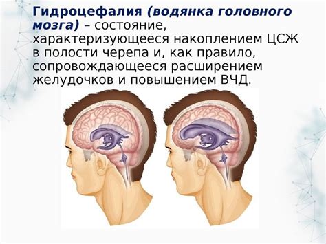 Наружная гидроцефалия головного мозга