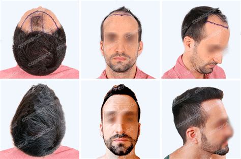 Пересадка волос в турции цена для мужчин 2022