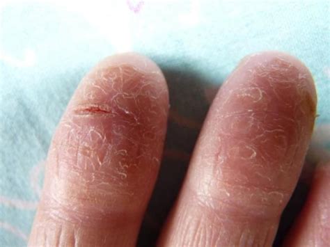 Трещины на пальцах рук лечение мази и крема отзывы цены