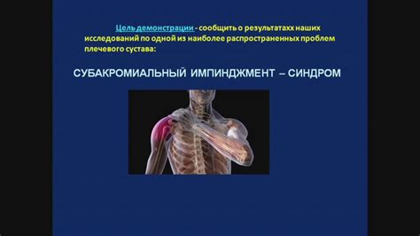 Импичмент синдром плечевого сустава